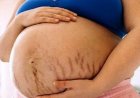 गर्भावस्था में स्ट्रेच मार्क्स? आयुर्वेद से जानिए बचाव के उपाय